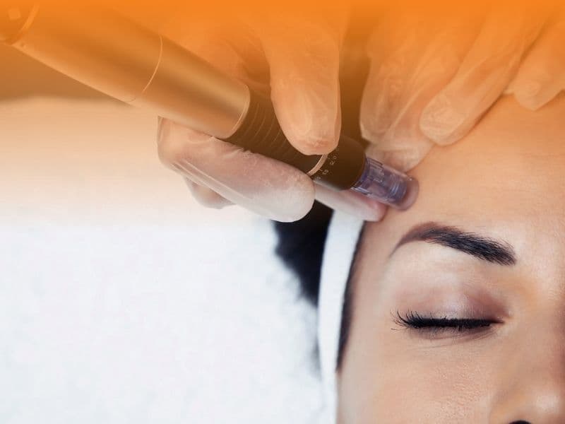 Microagulhamento facial com caneta Dermapen