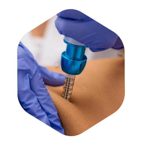 Aplicação de intradermoterapia pressurizada com caneta sem agulha